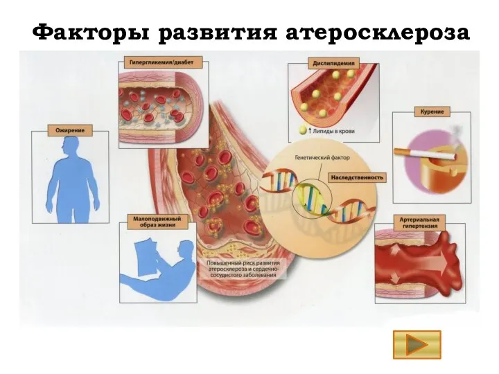 Факторы развития атеросклероза