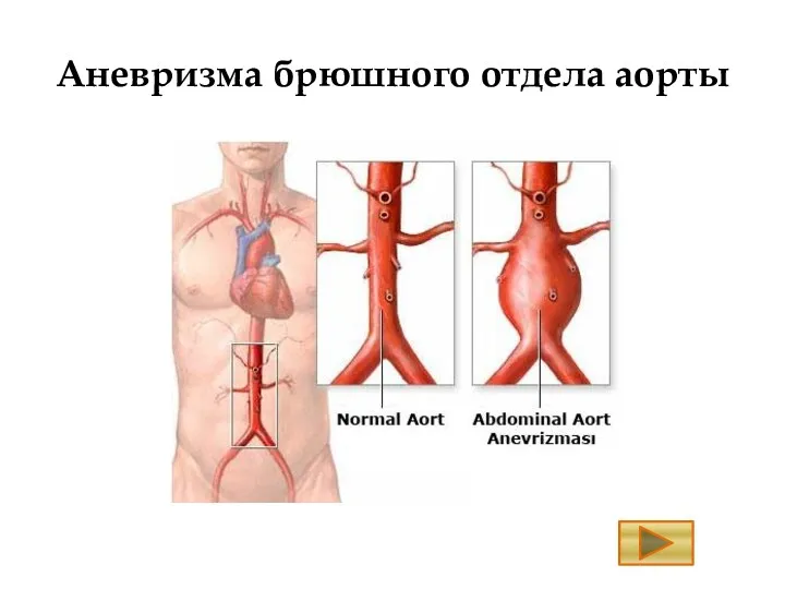Аневризма брюшного отдела аорты