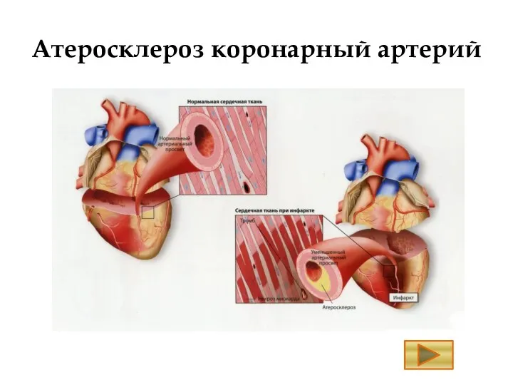 Атеросклероз коронарный артерий