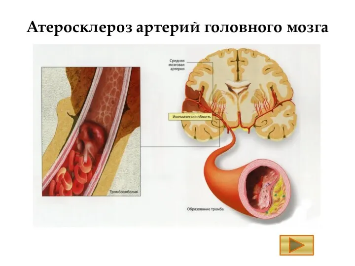 Атеросклероз артерий головного мозга