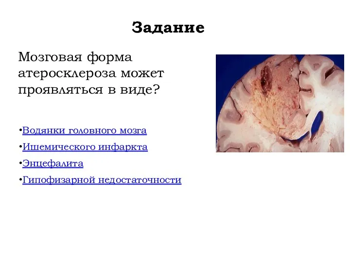 Задание Мозговая форма атеросклероза может проявляться в виде? Водянки головного мозга Ишемического инфаркта Энцефалита Гипофизарной недостаточности