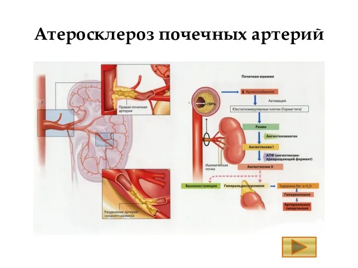 Атеросклероз почечных артерий
