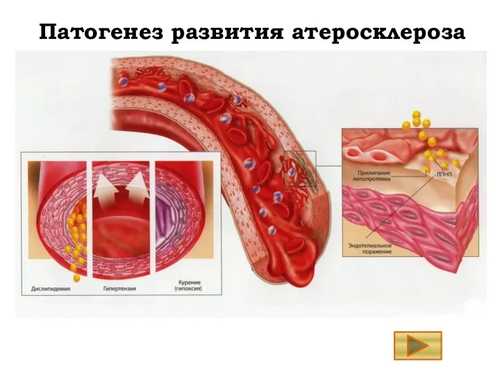 Патогенез развития атеросклероза