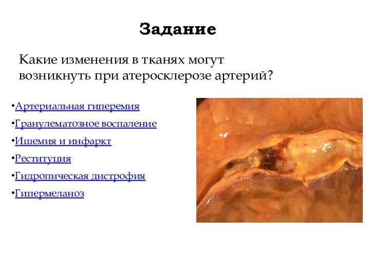 Задание Какие изменения в тканях могут возникнуть при атеросклерозе артерий?