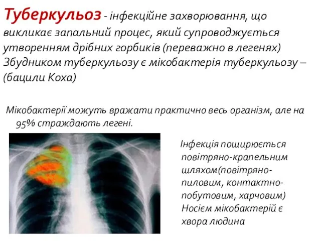 Туберкульоз - інфекційне захворювання, що викликає запальний процес, який супроводжується утворенням дрібних горбиків