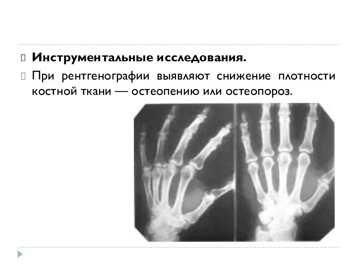 Инструментальные исследования. При рентгенографии выявляют снижение плотности костной ткани — остеопению или остеопороз.