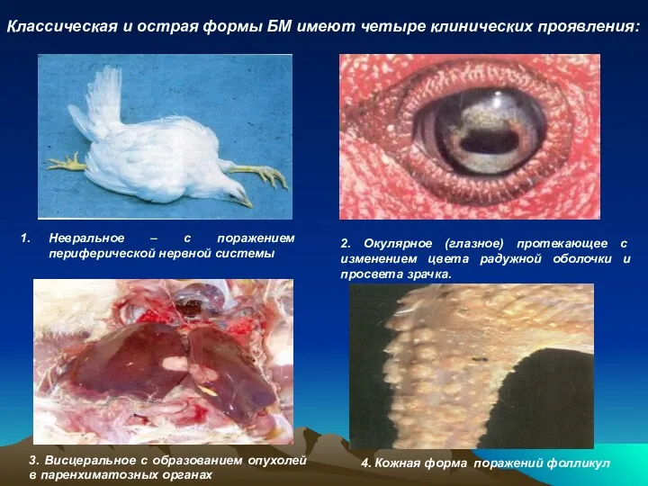 Классическая и острая формы БМ имеют четыре клинических проявления: Невральное