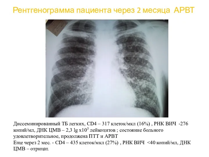 Рентгенограмма пациента через 2 месяца АРВТ Диссеминированный ТБ легких, CD4
