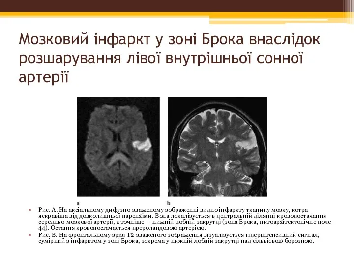 Мозковий інфаркт у зоні Брока внаслідок розшарування лівої внутрішньої сонної