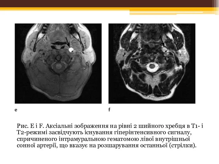 Рис. Е і F. Аксіальні зображення на рівні 2 шийного
