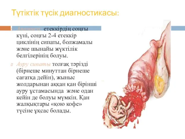 Түтіктік түсік диагностикасы: Анамнезі: етеккірдің соңғы күні, соңғы 2-4 етеккір