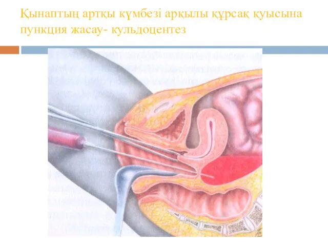 Қынаптың артқы күмбезі арқылы құрсақ қуысына пункция жасау- кульдоцентез