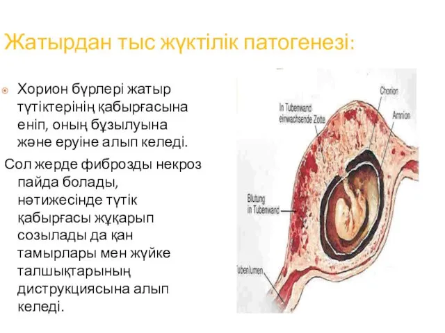 Жатырдан тыс жүктілік патогенезі: Хорион бүрлері жатыр түтіктерінің қабырғасына еніп,