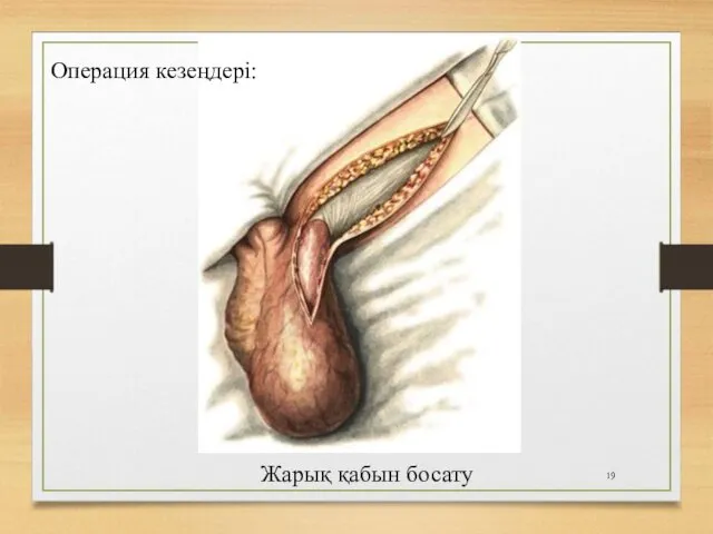 Жарық қабын босату Операция кезеңдері: