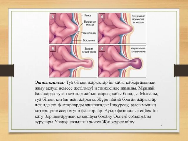 Этиологиясы: Туа бiткен жарықтар iш қабы қабырғасының даму ақауы немесе