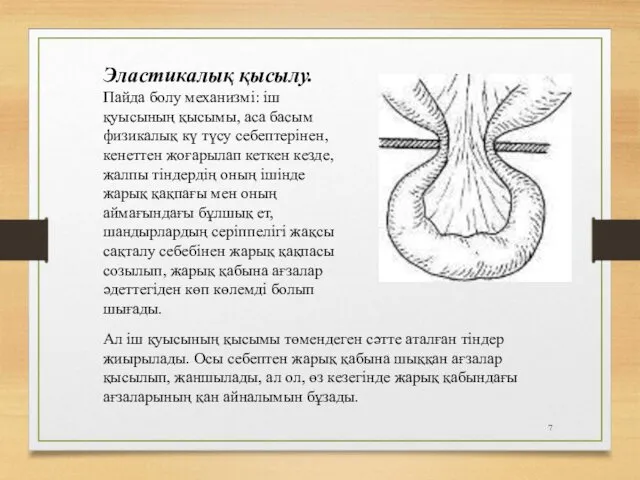 Эластикалық қысылу. Пайда болу механизмі: іш қуысының қысымы, аса басым