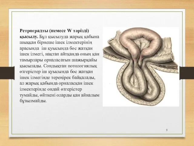 Ретроградты (немесе W тәрізді) қысылу. Бұл қысылуда жарық қабына шыққан