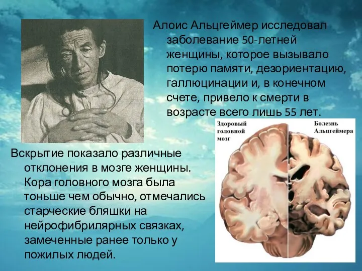 Вскрытие показало различные отклонения в мозге женщины. Кора головного мозга