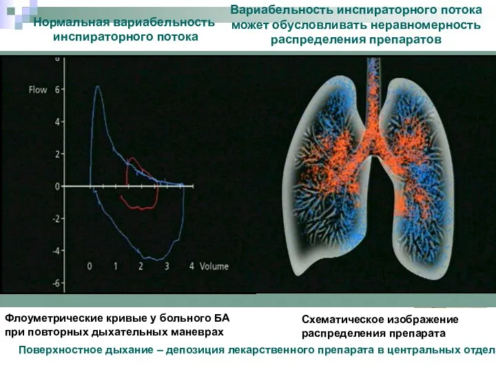 Флоуметрические кривые у больного БА при повторных дыхательных маневрах Нормальная