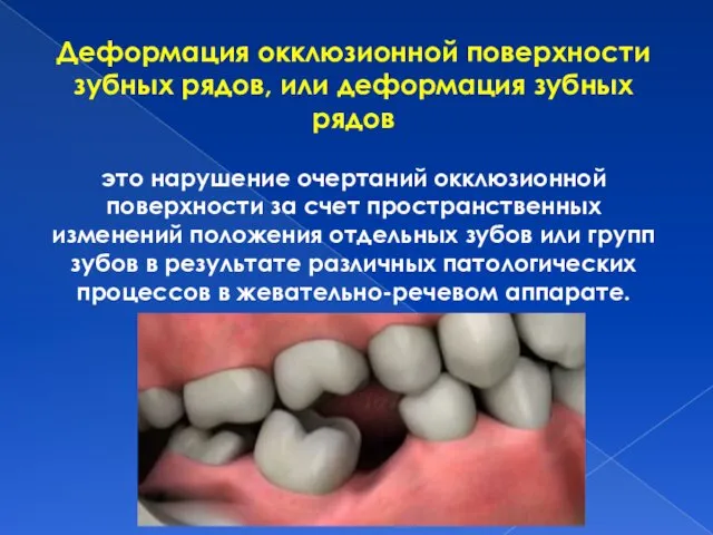 Деформация окклюзионной поверхности зубных рядов, или деформация зубных рядов это
