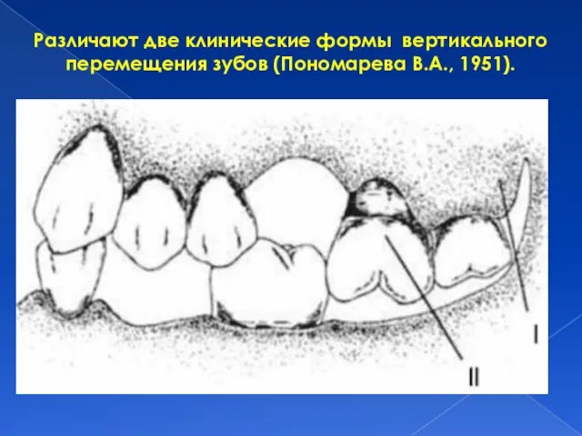 Различают две клинические формы вертикального перемещения зубов (Пономарева В.А., 1951).