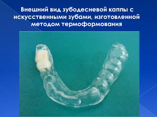 Внешний вид зубодесневой каппы с искусственными зубами, изготовленной методом термоформования