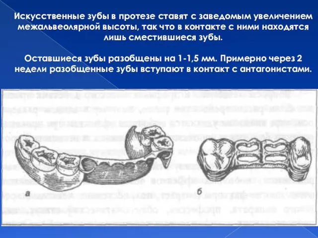 Искусственные зубы в протезе ставят с заведомым увеличением межальвеолярной высоты,