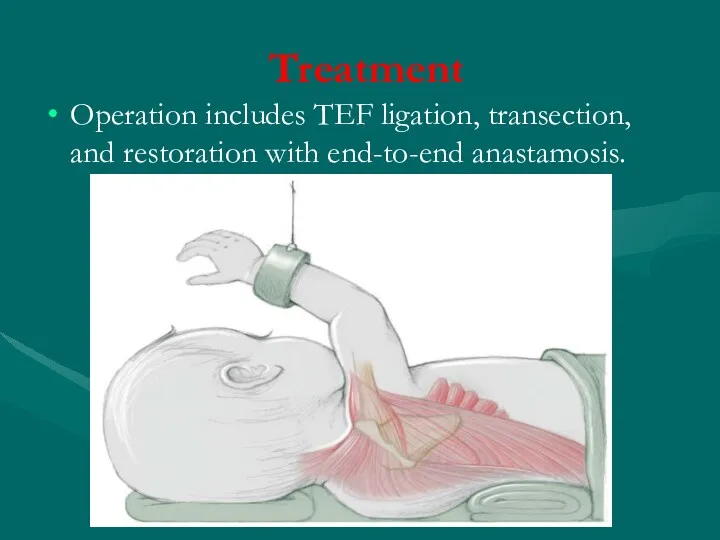 Treatment Operation includes TEF ligation, transection, and restoration with end-to-end anastamosis.