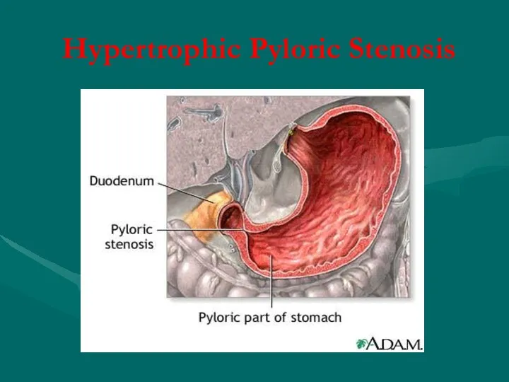 Hypertrophic Pyloric Stenosis