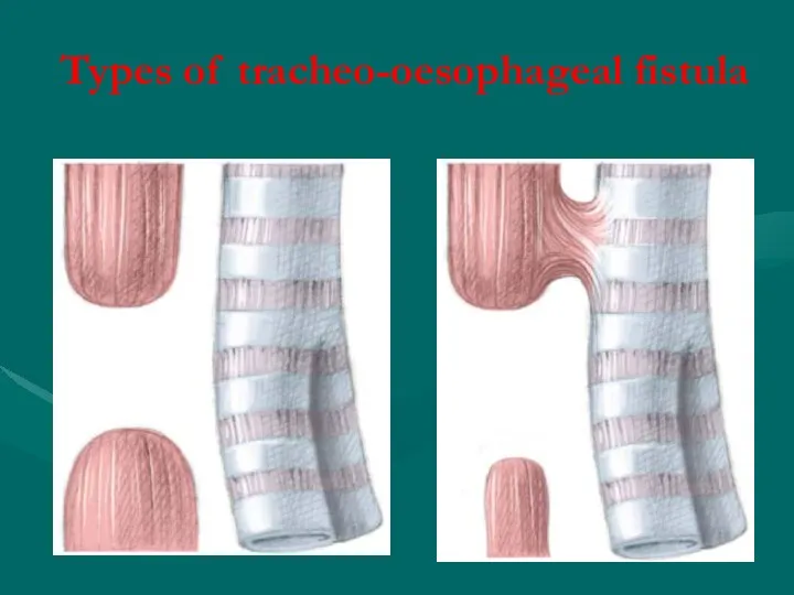 Types of tracheo-oesophageal fistula