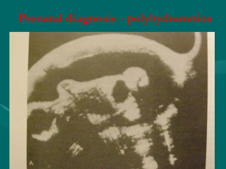 Prenatal diagnosis - polyhydramnios
