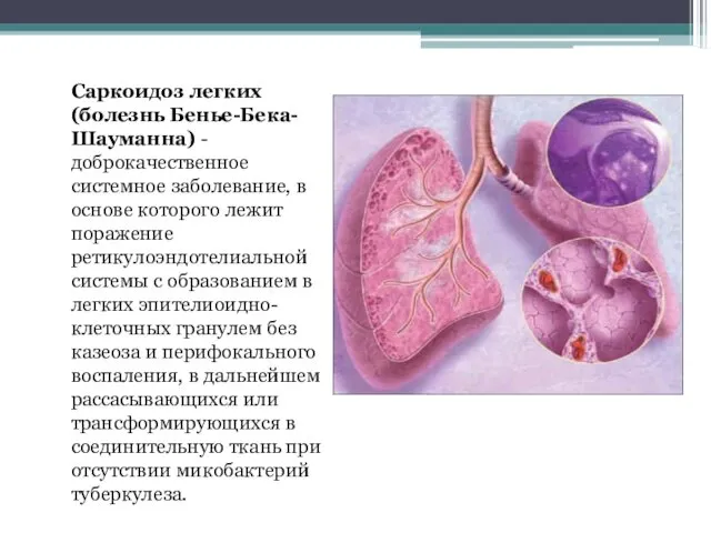 Саркоидоз легких (болезнь Бенье-Бека-Шауманна) - доброкачественное системное заболевание, в основе