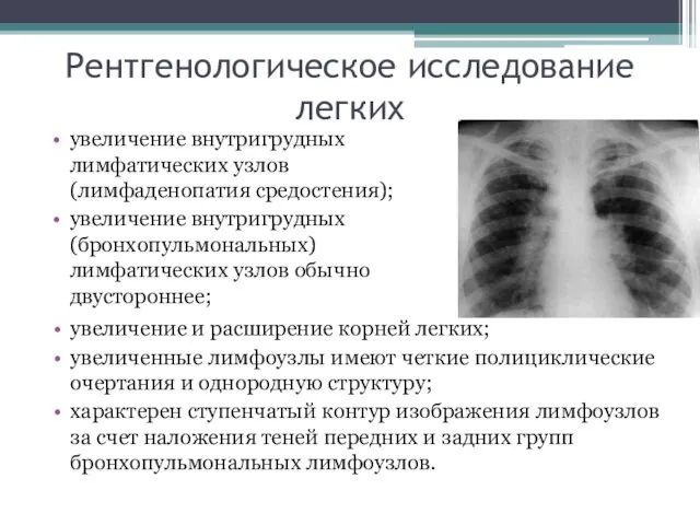 Рентгенологическое исследование легких увеличение внутригрудных лимфатических узлов (лимфаденопатия средостения); увеличение