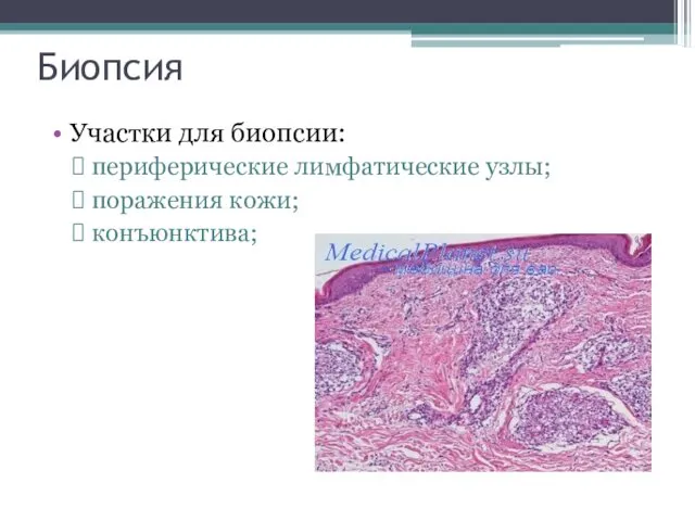 Биопсия Участки для биопсии: периферические лимфатические узлы; поражения кожи; конъюнктива;