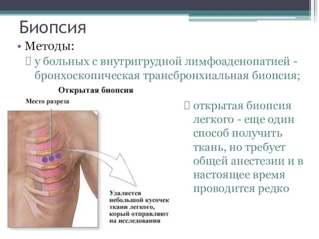 Биопсия Методы: у больных с внутригрудной лимфоаденопатией - бронхоскопическая трансбронхиальная