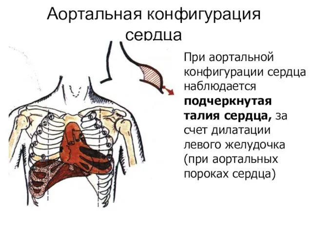 Аортальная конфигурация сердца При аортальной конфигурации сердца наблюдается подчеркнутая талия