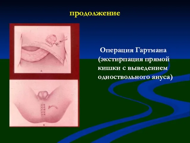 продолжение Операция Гартмана (экстирпация прямой кишки с выведением одноствольного ануса)