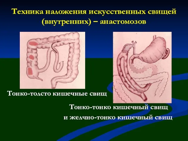 Техника наложения искусственных свищей (внутренних) – анастомозов Тонко-толсто кишечные свищ Тонко-тонко кишечный свищ