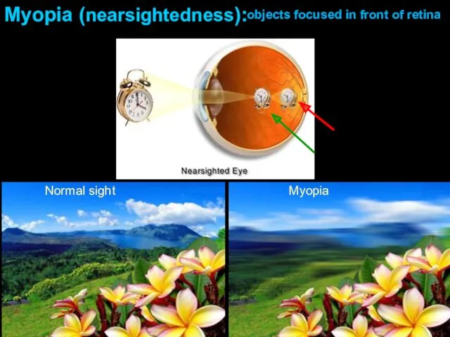 Normal sight Myopia Myopia (nearsightedness): objects focused in front of retina