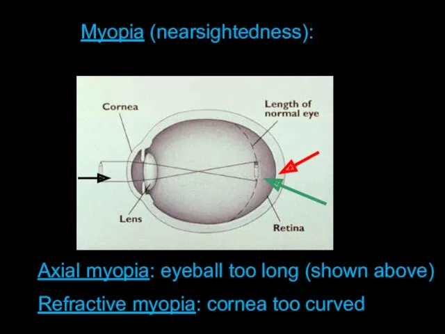 Length of Eyeball + Curvature of Cornea Myopia (nearsightedness): Axial myopia: eyeball too