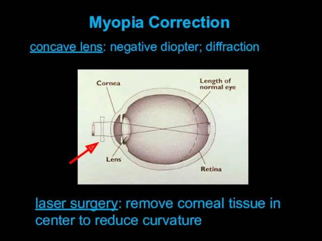 concave lens: negative diopter; diffraction Myopia Correction laser surgery: remove corneal tissue in