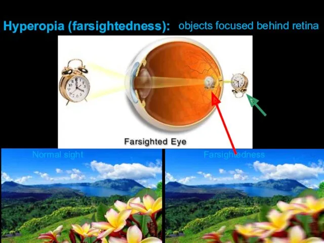 Normal sight Farsightedness Hyperopia (farsightedness): objects focused behind retina
