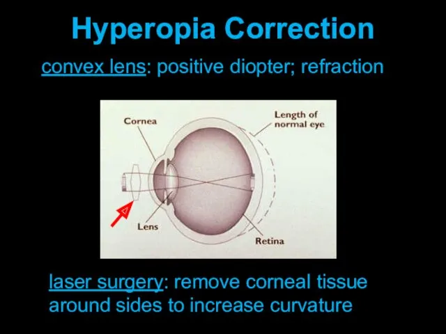 convex lens: positive diopter; refraction Hyperopia Correction laser surgery: remove corneal tissue around