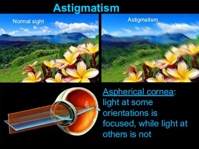 Normal sight Astigmatism Astigmatism Aspherical cornea: light at some orientations is focused, while