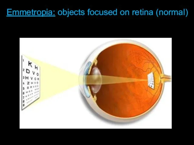 Length of Eyeball + Curvature of Cornea Emmetropia: objects focused on retina (normal)