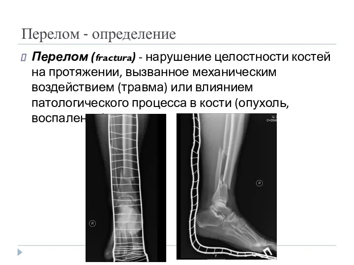 Перелом - определение Перелом (fractura) - нарушение целостности костей на