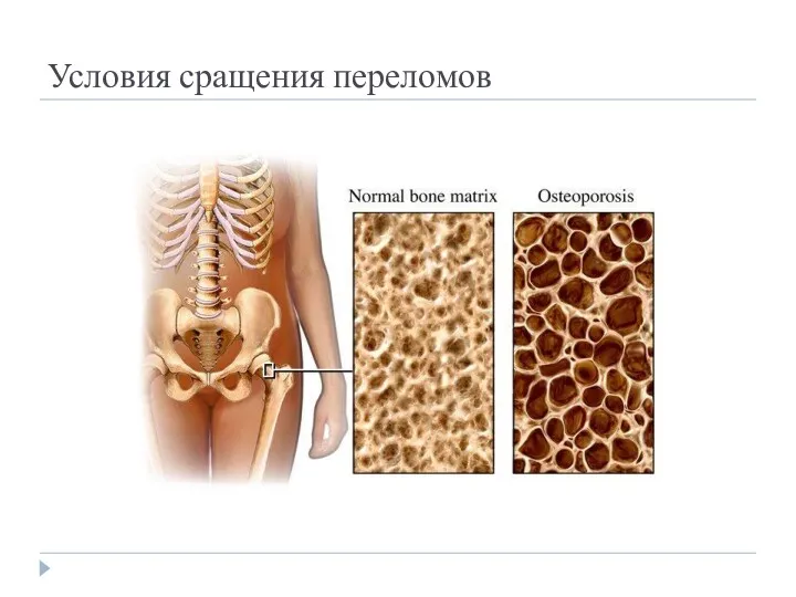 Условия сращения переломов