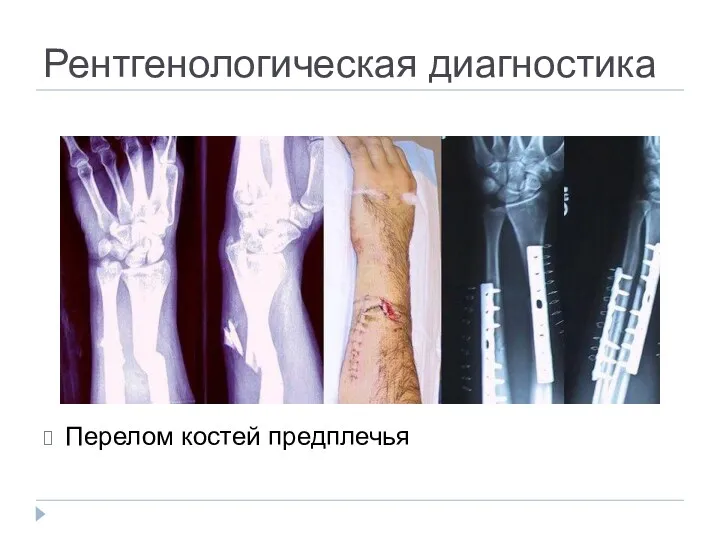 Рентгенологическая диагностика Перелом костей предплечья