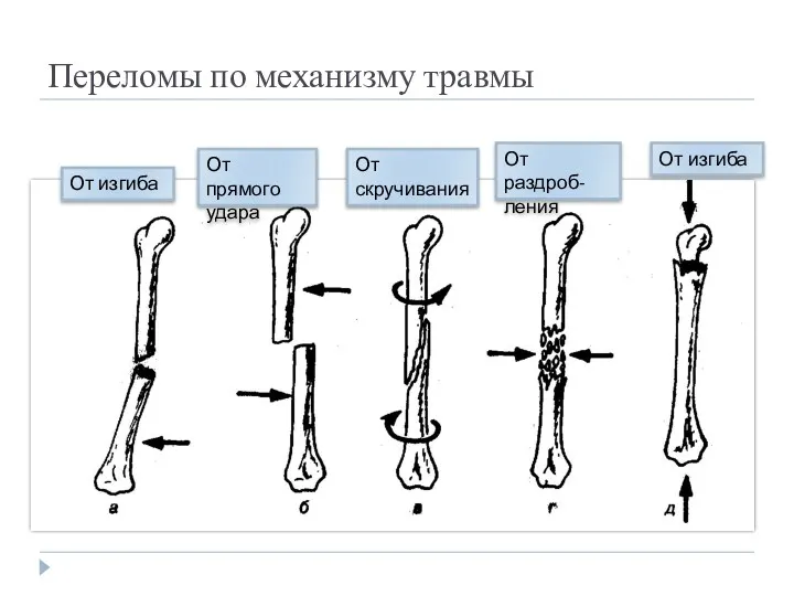 Переломы по механизму травмы От изгиба От прямого удара От скручивания От раздроб-ления От изгиба