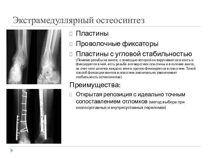 Экстрамедуллярный остеосинтез Пластины Проволочные фиксаторы Пластины с угловой стабильностью (Помимо